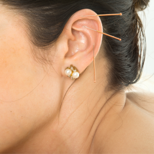 Emma’s experience with Auricular Acupuncture